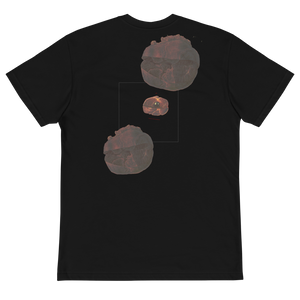 THE SPLEENIC INFARCTUS TEE