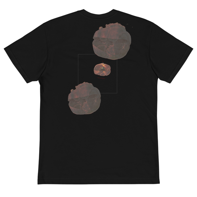 THE SPLEENIC INFARCTUS TEE